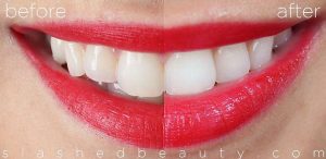 tips for whiter teeth
