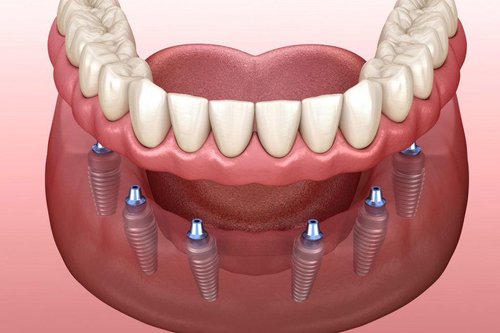 implant-supported dentures illustration