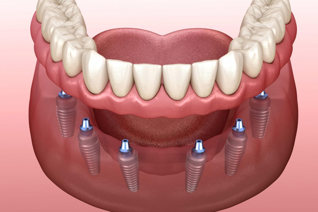 implant-supported full and partial dentures illustration