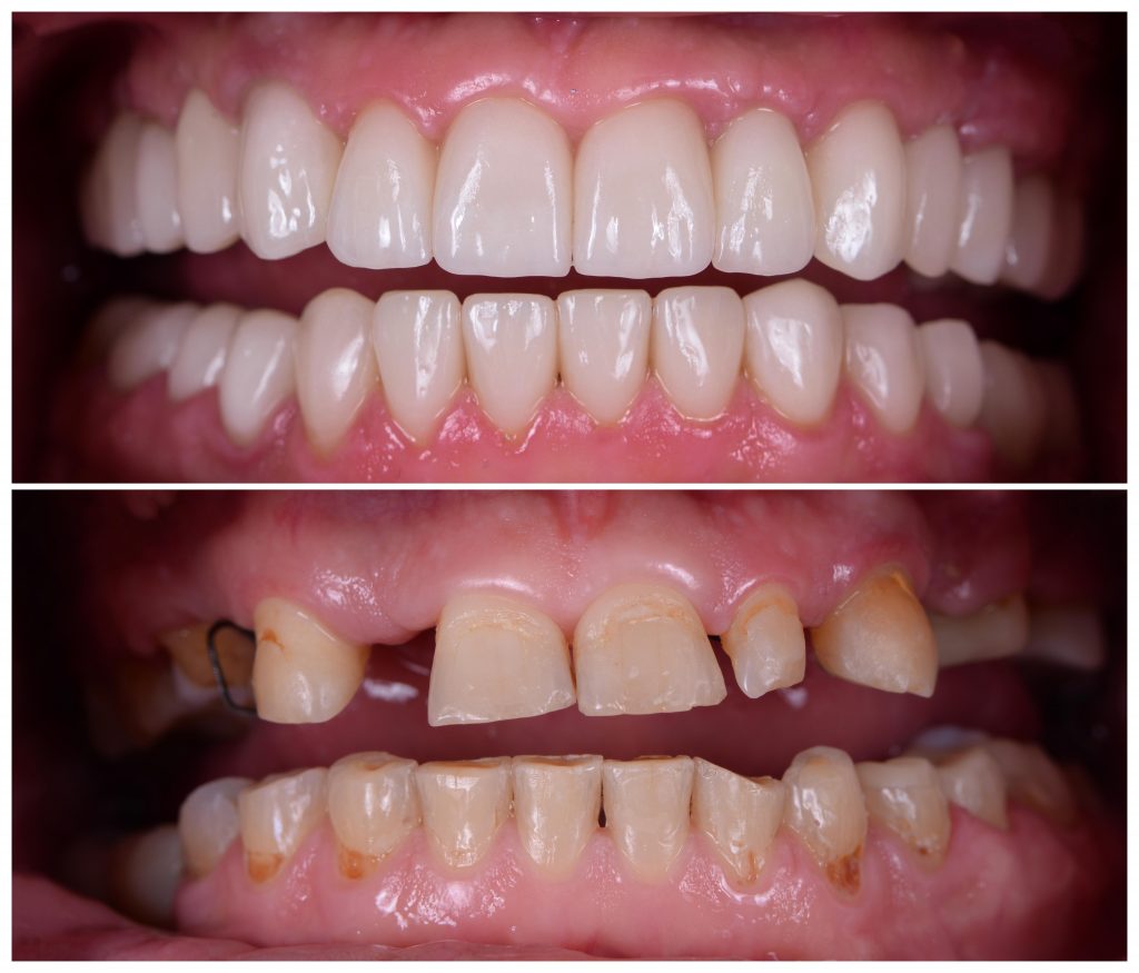 before and after dental implants