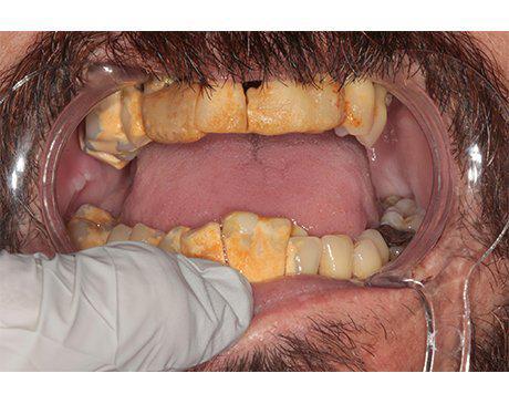 male patient with rotted teeth